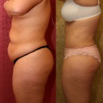 Tummy Tuck (Abdominoplasty) Medium Size Before & After Patient #5755