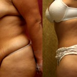 Tummy Tuck (Abdominoplasty) Medium Size Before & After Patient #5817