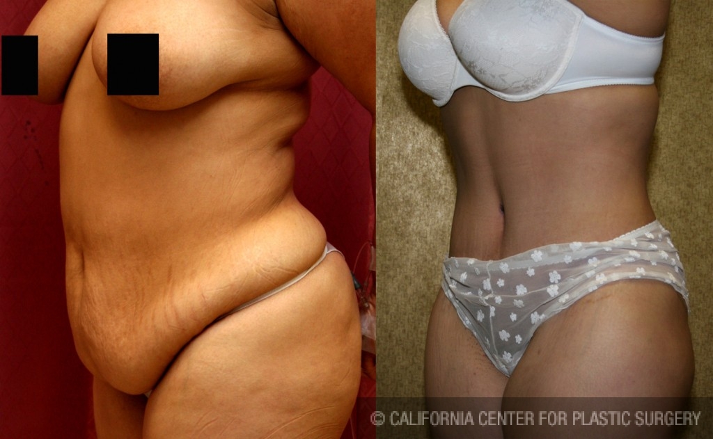 Tummy Tuck (Abdominoplasty) Medium Size Before & After Patient #5817