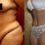 Tummy Tuck (Abdominoplasty) Medium Size Before & After Patient #5817