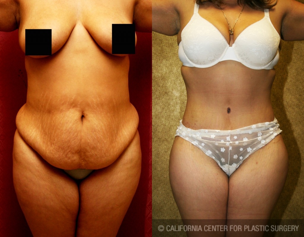 Tummy Tuck (Abdominoplasty) Medium Size Before & After Patient #5817