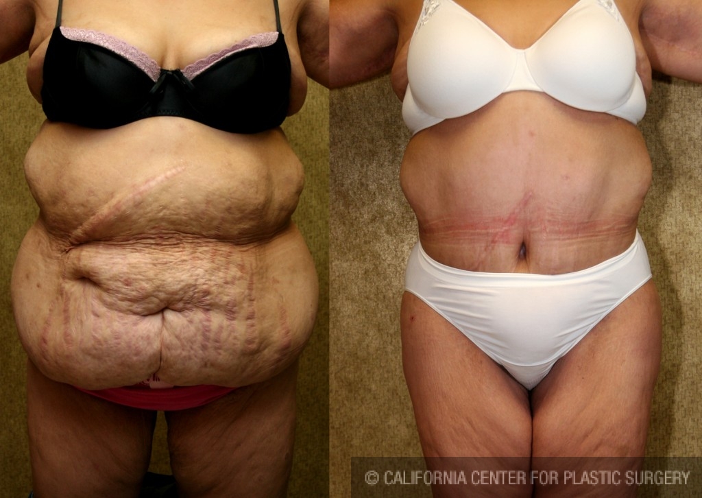 Before and After Tummy Tuck