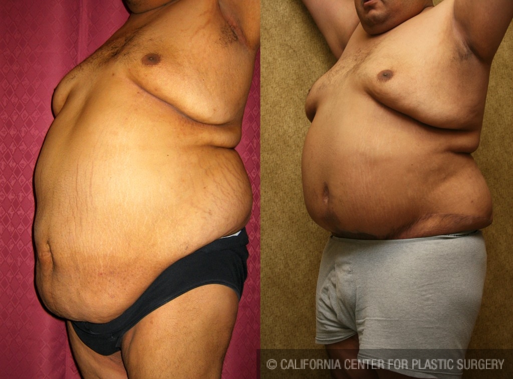 Tummy Tuck (Abdominoplasty) Plus Size Before & After Patient #5903