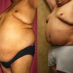 Tummy Tuck (Abdominoplasty) Plus Size Before & After Patient #5903