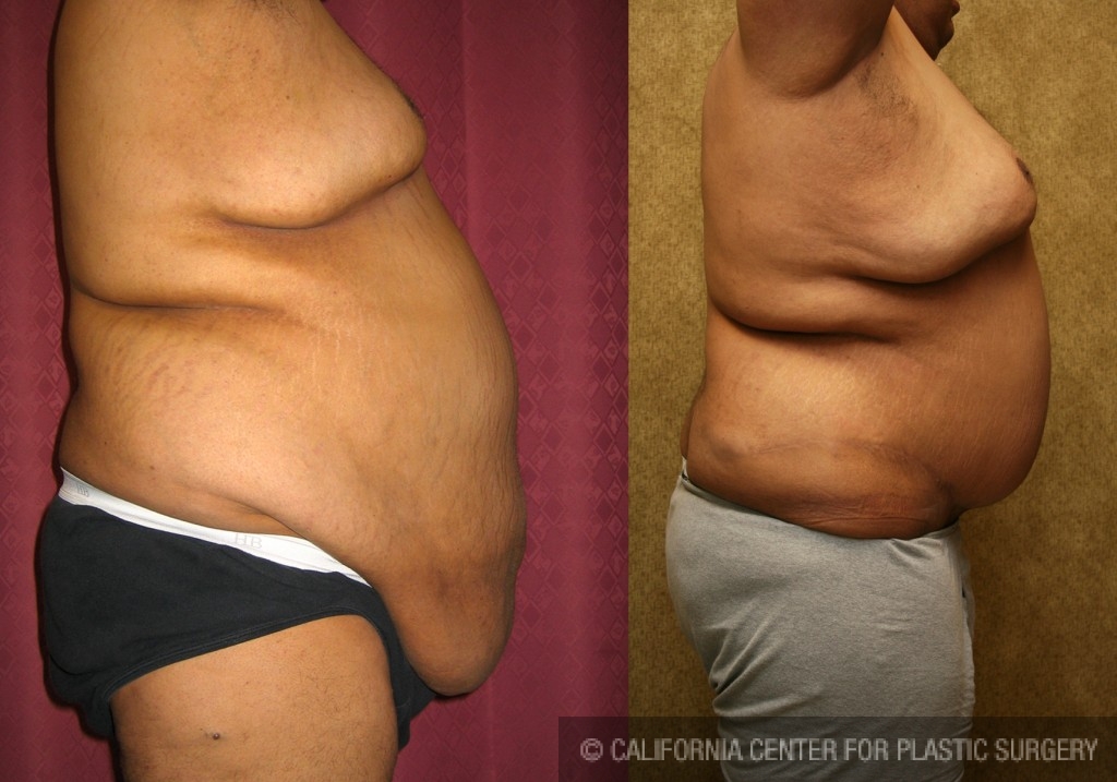 Male Tummy Tuck (abdominoplasty) Before & After Patient #6027