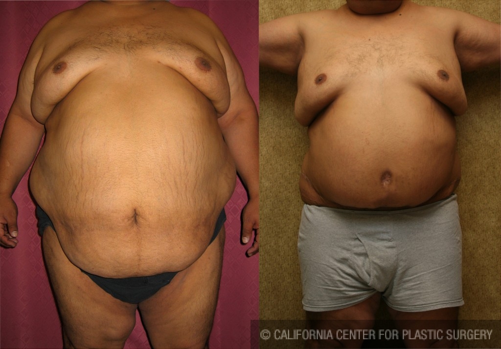 Male Tummy Tuck (abdominoplasty) Before & After Patient #6027