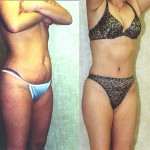 Tummy Tuck (Abdominoplasty) Small Size Before & After Patient #5750