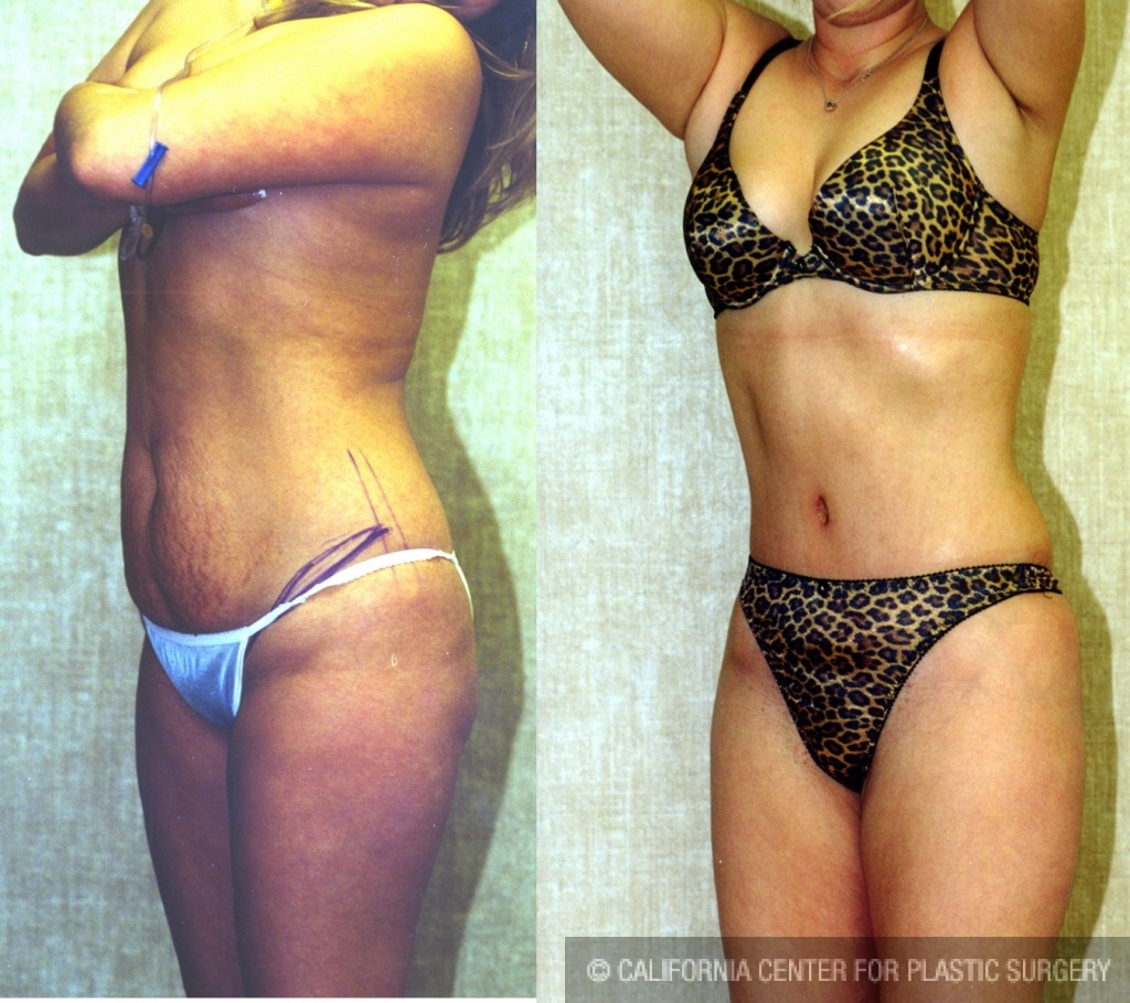 Tummy Tuck (Abdominoplasty) Small Size Before & After Patient #5750