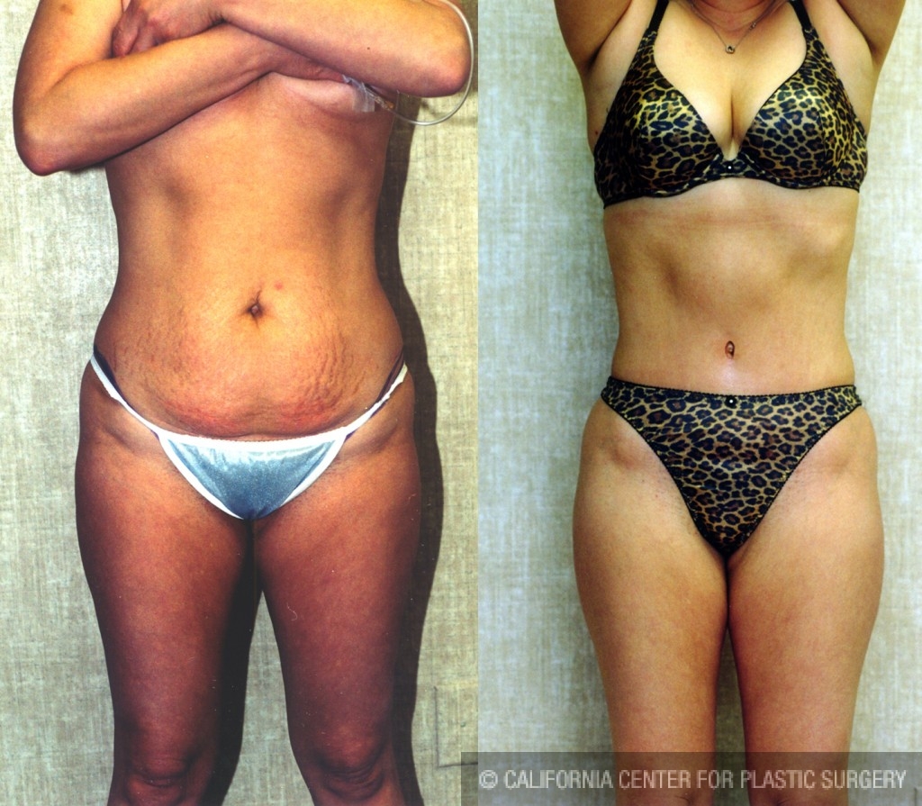 Tummy Tuck (Abdominoplasty) Small Size Before & After Patient #5750