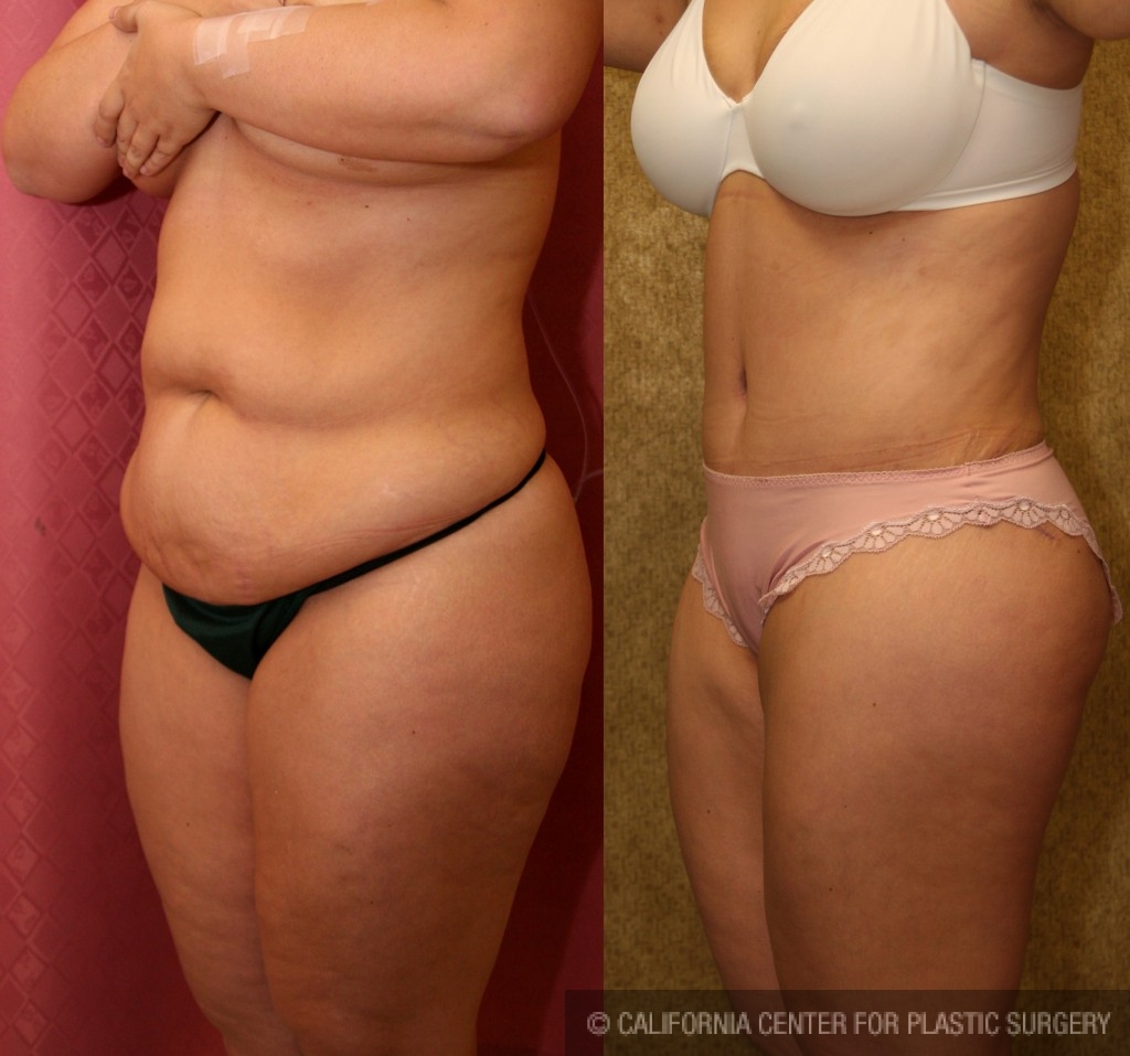 Tummy Tuck (Abdominoplasty) Medium Size Before & After Patient #5755