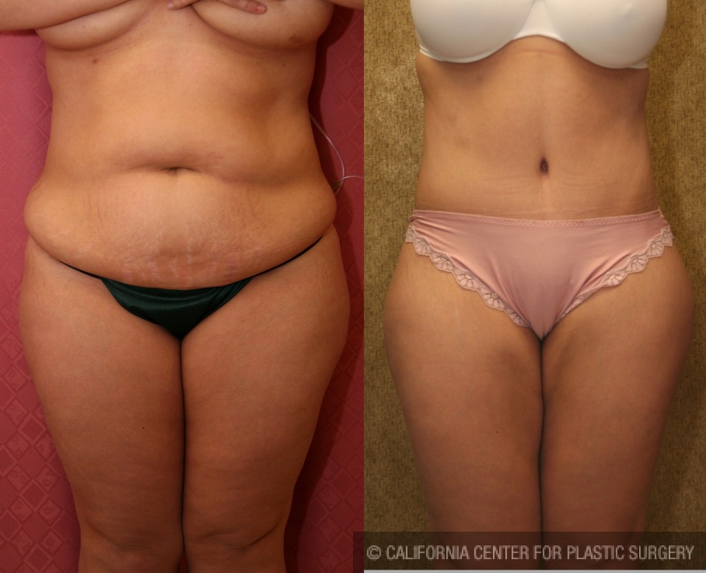 Tummy Tuck (Abdominoplasty) Medium Size Before & After Patient #5755