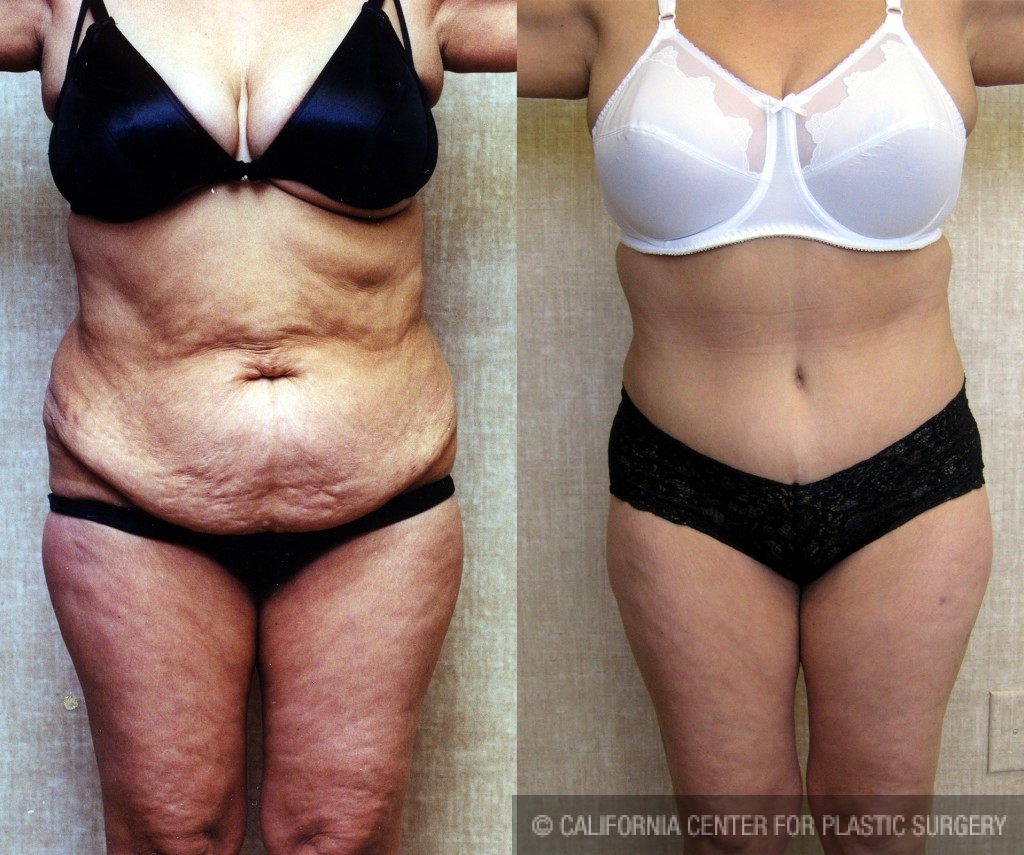Tummy Tuck (Abdominoplasty) Medium Size Before & After Patient #5769