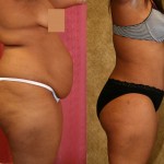 African American Tummy Tuck (Abdominoplasty) Before & After Patient #5957