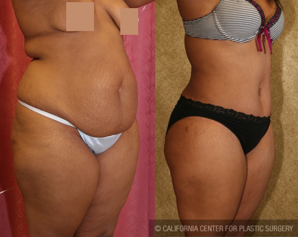 African American Tummy Tuck (Abdominoplasty) Before & After Patient #5957