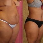 African American Tummy Tuck (Abdominoplasty) Before & After Patient #5957