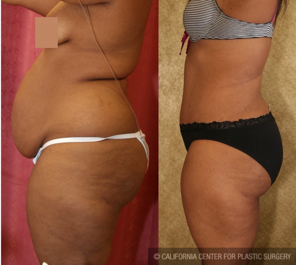 African American Tummy Tuck (Abdominoplasty) Before & After Patient #5957