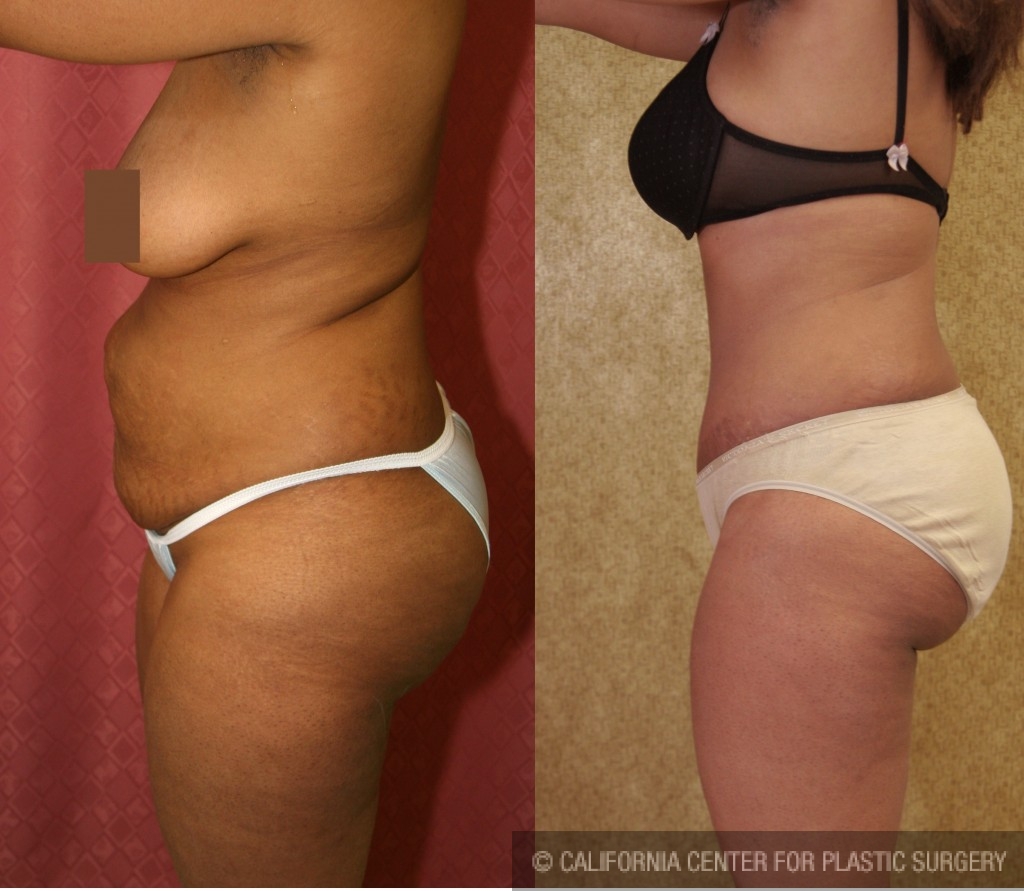 African American Tummy Tuck (Abdominoplasty) Before & After Patient #5963