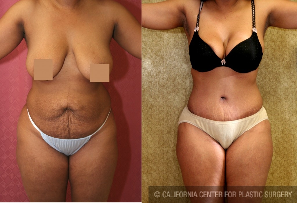 African American Tummy Tuck (Abdominoplasty) Before & After Patient #5963
