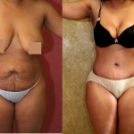 African American Tummy Tuck (Abdominoplasty) Before & After Patient #5963