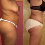 African American Tummy Tuck (Abdominoplasty) Before & After Patient #5963