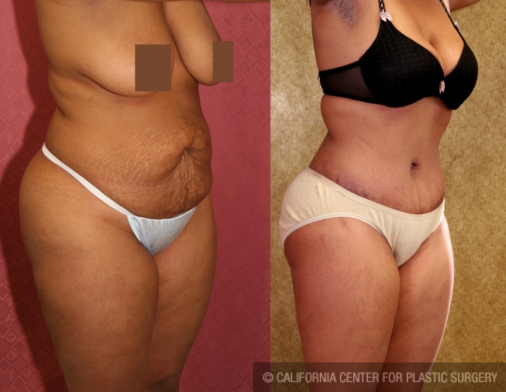 African American Tummy Tuck (Abdominoplasty) Before & After Patient #5963