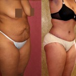 African American Tummy Tuck (Abdominoplasty) Before & After Patient #5963