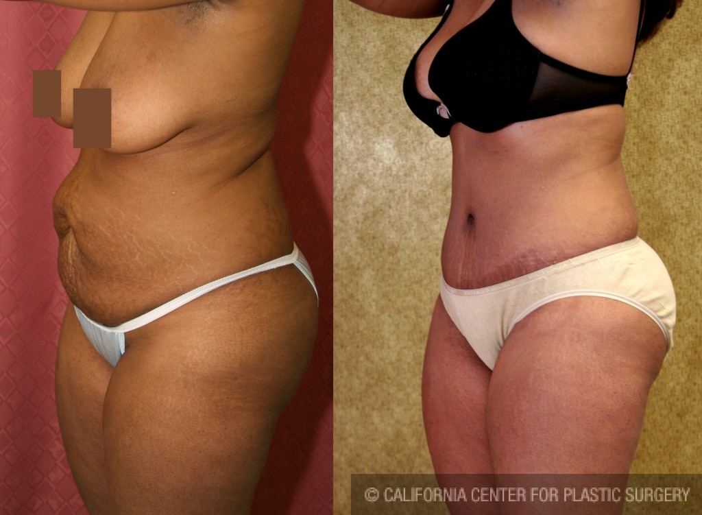 African American Tummy Tuck (Abdominoplasty) Before & After Patient #5963