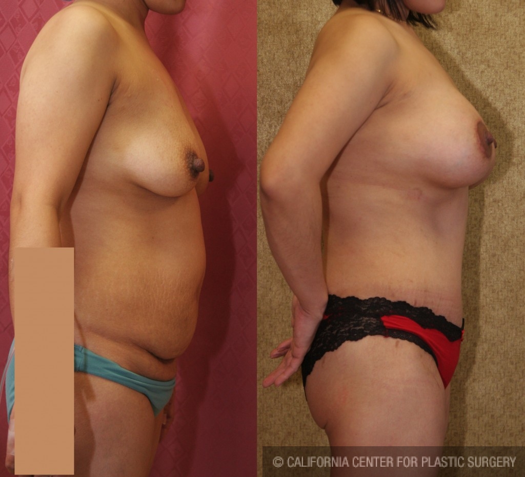 Tummy Tuck (Abdominoplasty) Medium Size Before & After Patient #5825