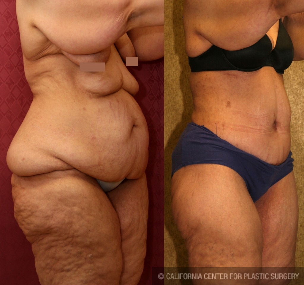 Tummy Tuck (Abdominoplasty) Plus Size Before & After Patient #5908