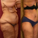 Tummy Tuck (Abdominoplasty) Plus Size Before & After Patient #5908