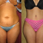 Tummy Tuck (Abdominoplasty) Medium Size Before & After Patient #5813