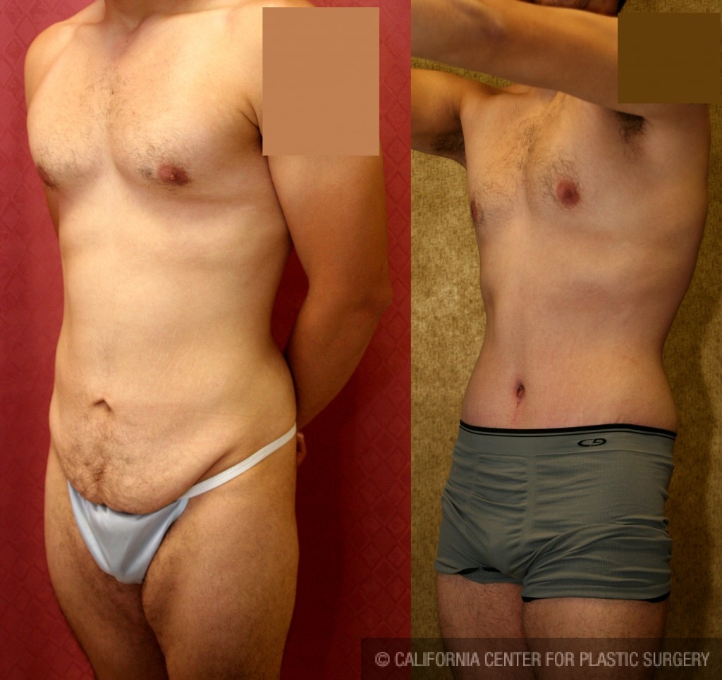 Male Tummy Tuck Before & After Patient #6009