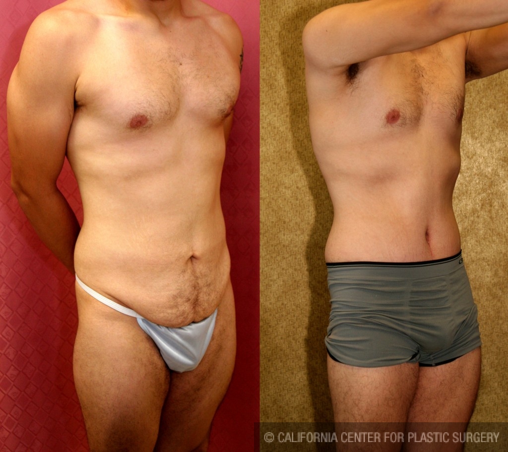 Male Tummy Tuck (abdominoplasty) Before & After Patient #6009