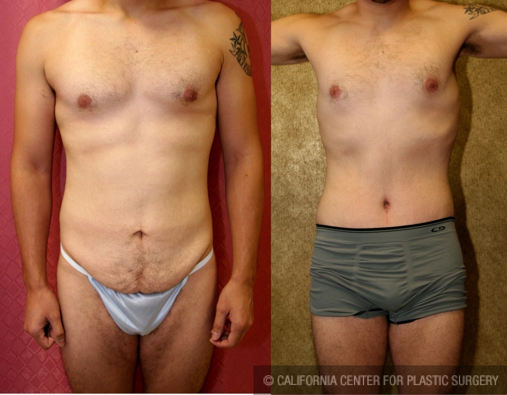 Male Tummy Tuck (abdominoplasty) Before & After Patient #6009