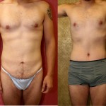 Male Tummy Tuck (abdominoplasty) Before & After Patient #6009