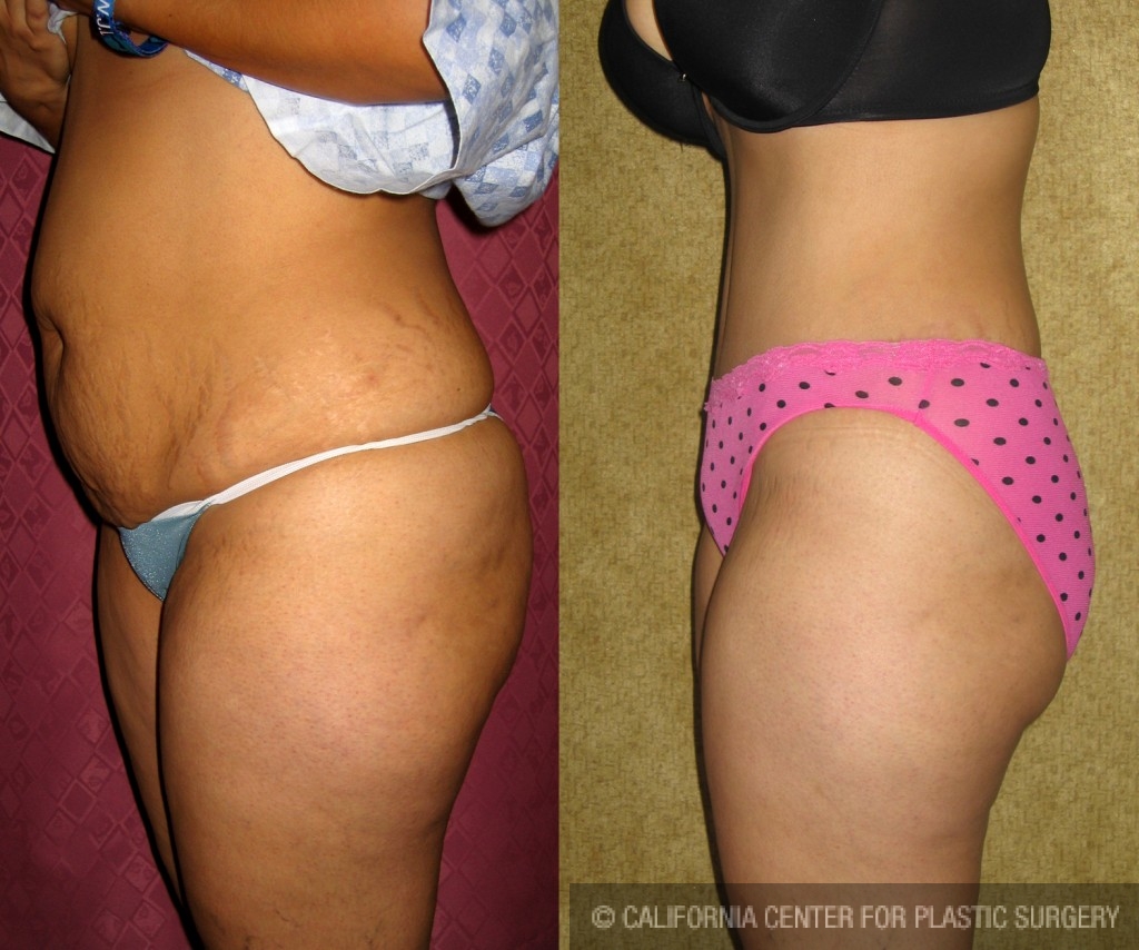 Tummy Tuck (Abdominoplasty) Medium Size Before & After Patient #5813