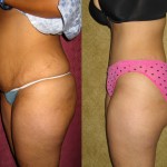 Tummy Tuck (Abdominoplasty) Medium Size Before & After Patient #5813