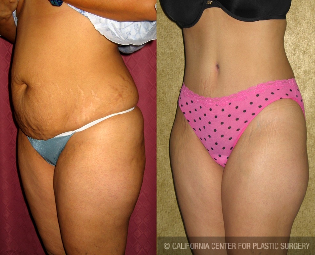 Tummy Tuck (Abdominoplasty) Medium Size Before & After Patient #5813
