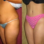 Tummy Tuck (Abdominoplasty) Medium Size Before & After Patient #5813