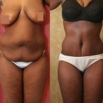 African American Tummy Tuck (Abdominoplasty) Before & After Patient #5969