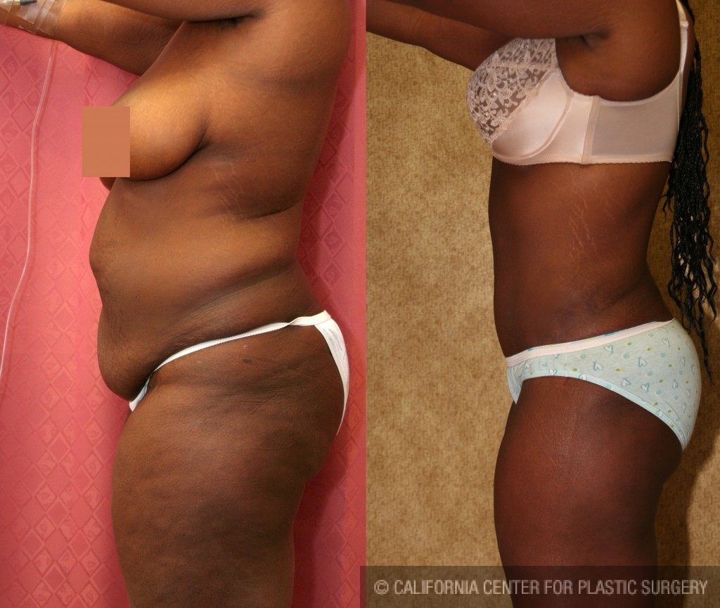African American Tummy Tuck (Abdominoplasty) Before & After Patient #5969