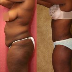 African American Tummy Tuck (Abdominoplasty) Before & After Patient #5969