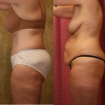 Tummy Tuck (Abdominoplasty) Medium Size Before & After Patient #5821