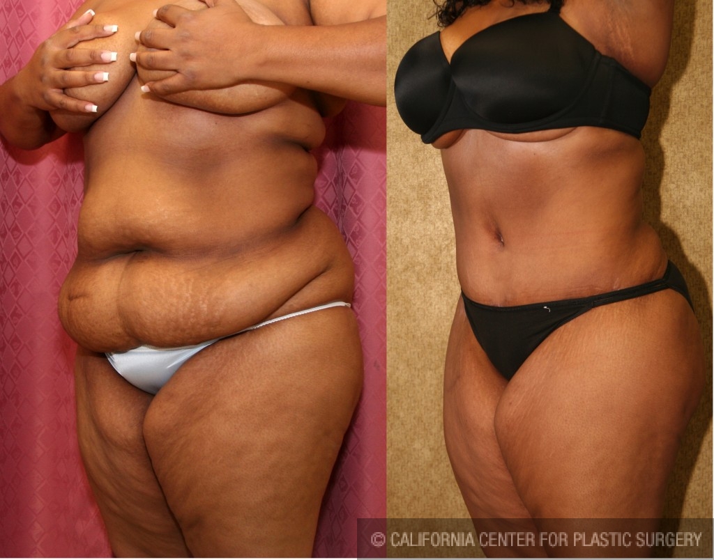 Tummy Tuck (Abdominoplasty) Plus Size Before & After Patient #5884