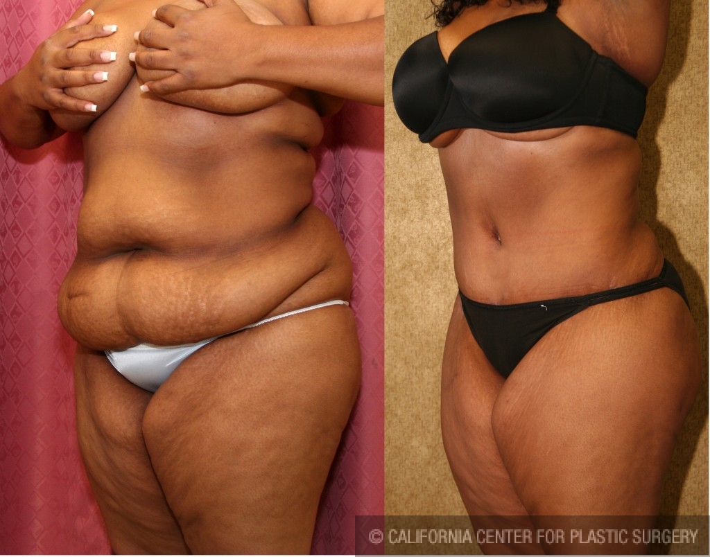 African American Tummy Tuck (Abdominoplasty) Before & After Patient #5940