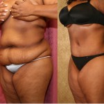 African American Tummy Tuck (Abdominoplasty) Before & After Patient #5940