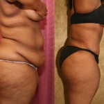 Tummy Tuck (Abdominoplasty) Plus Size Before & After Patient #5884