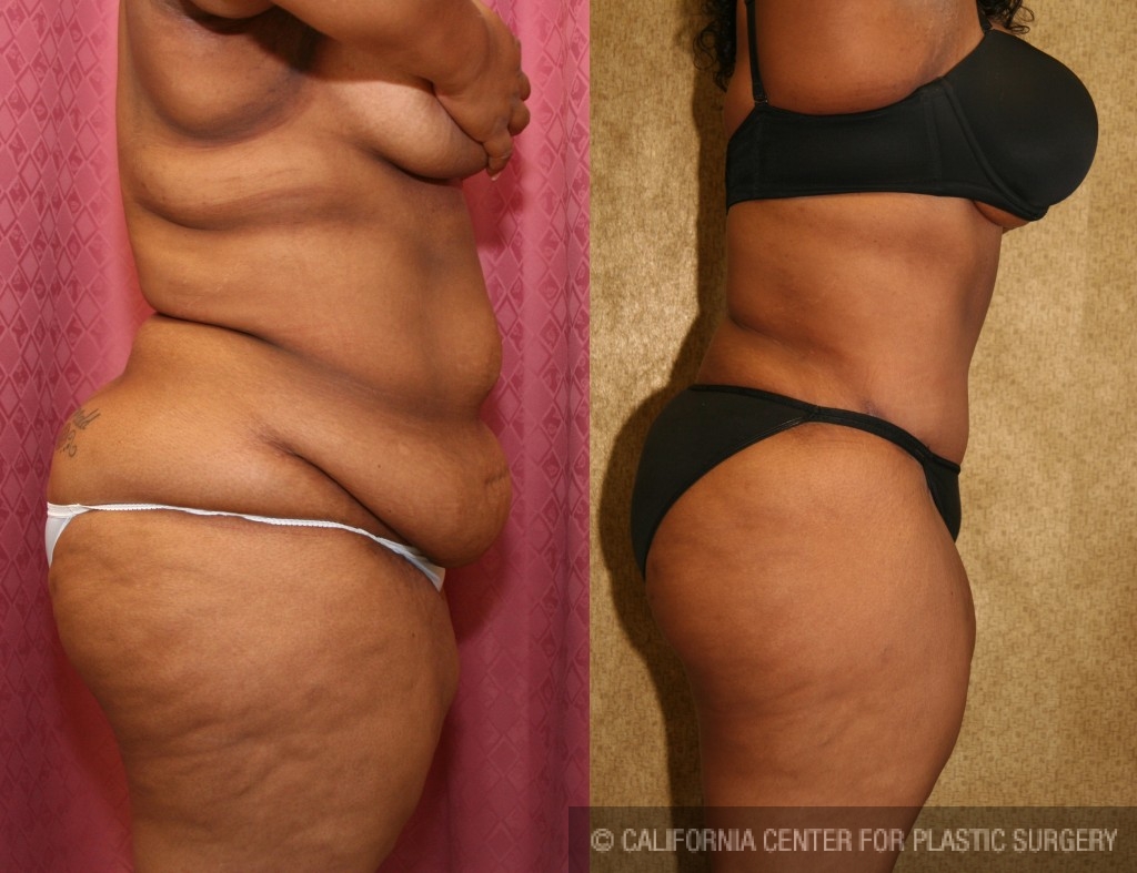 African American Tummy Tuck (Abdominoplasty) Before & After Patient #5940