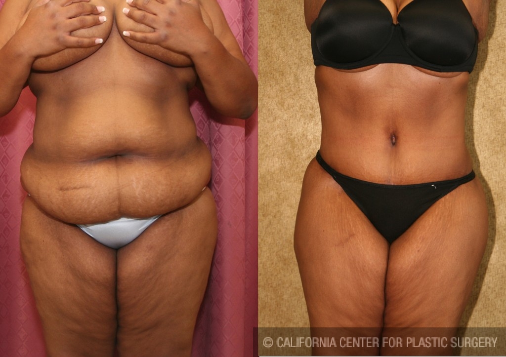 Tummy Tuck (Abdominoplasty) Plus Size Before & After Patient #5884