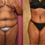 Tummy Tuck (Abdominoplasty) Plus Size Before & After Patient #5884
